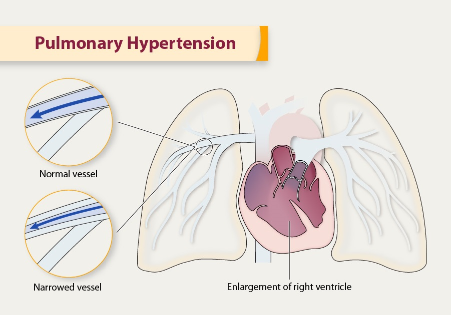 Pulmoner Hipertansiyon