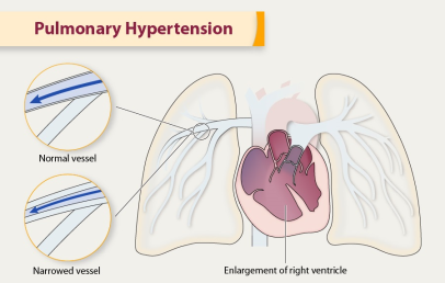 Pulmoner Hipertansiyon